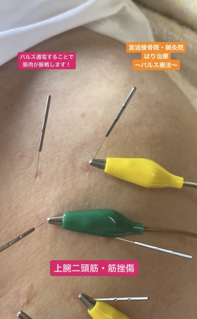 筋挫傷の治療の一端